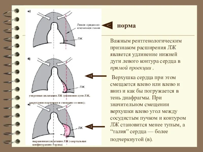 Что значит сердце увеличено влево