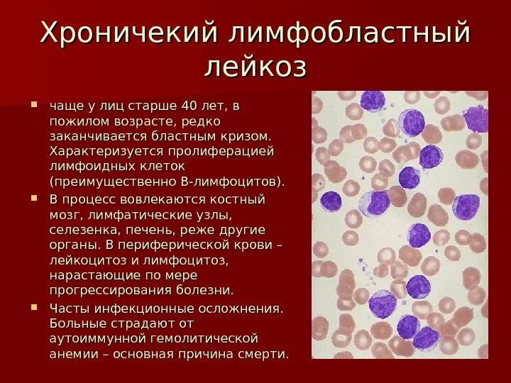 Острый лимфоцитарный лейкоз. Лимфобластный лейкоз бластные клетки. Острый лейкоз мазок крови. Острый лейкоз картина крови.