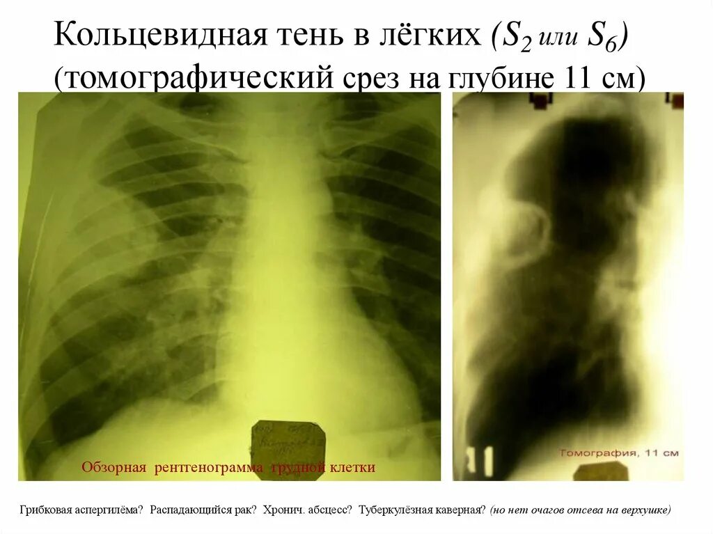 Кольцевидная тень туберкулез. Синдром кольцевидной тени рентген. Кольцевидные тени в легких на рентгене. Кольцевидная тень на флюорографии. Верхушки легких тени