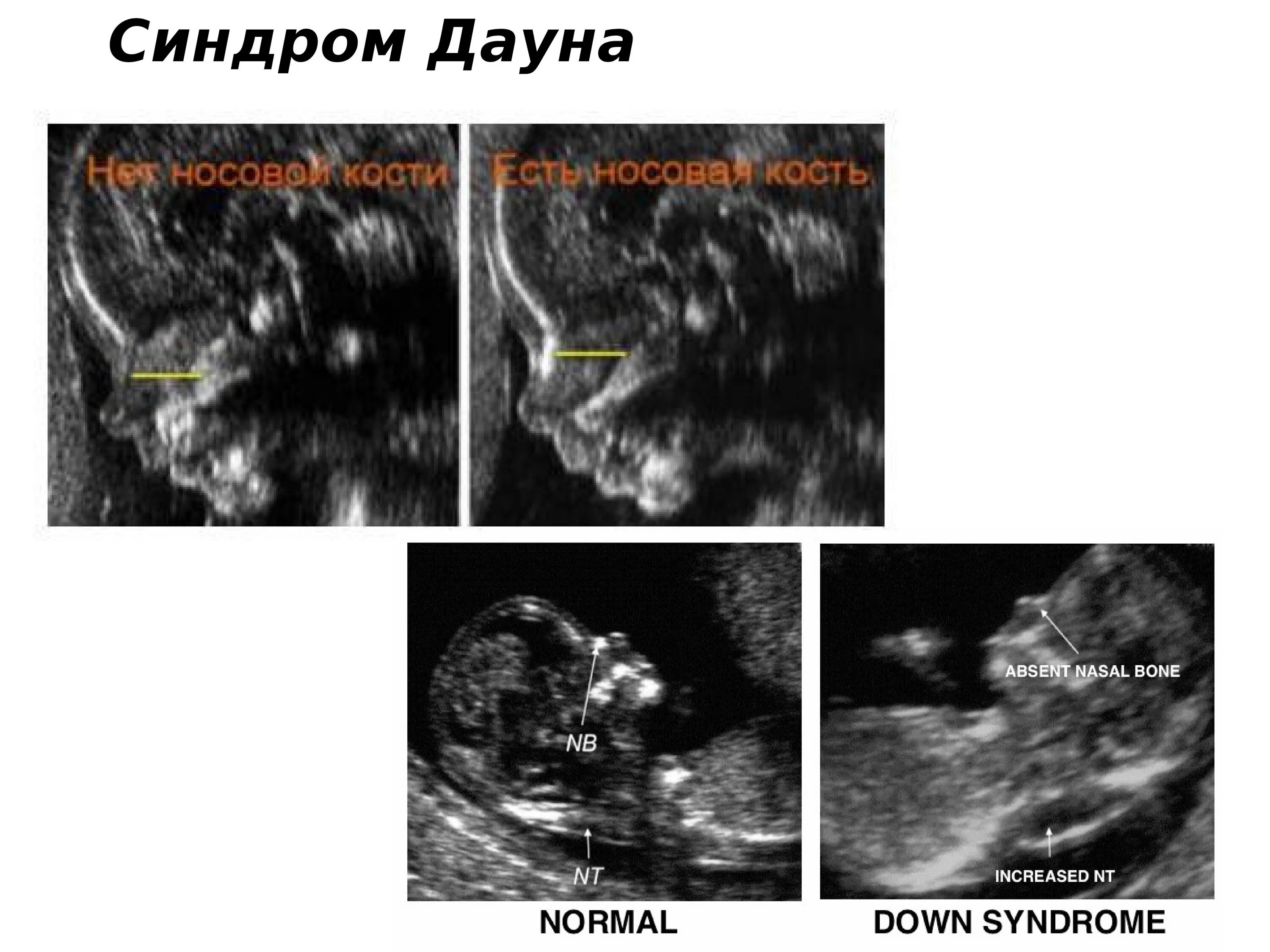 Узи аномалий. УЗИ на 12 недели беременности с синдромом Дауна. Синдром Дауна на УЗИ 12 недель. Признаки синдрома Дауна на УЗИ В 20 недель. Синдром Дауна на УЗИ 20 недель.