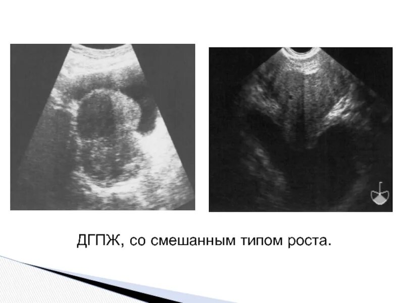 Дгпж с внутрипузырным ростом что это. Доброкачественная гиперплазия предстательной. Эпидемиология доброкачественной гиперплазии предстательной железы. Узи доброкачественная гиперплазия предстательной железы. Стромальная гиперплазия предстательной железы.