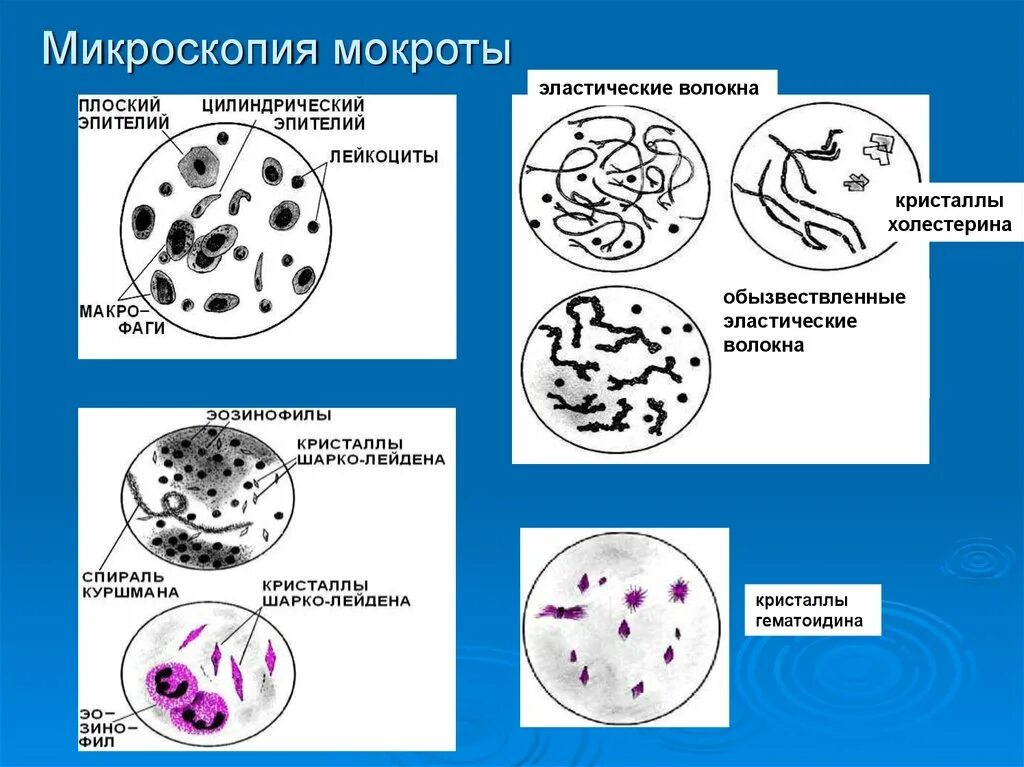 Элементы мокроты. Эластические волокна в мокроте микроскопия. Исследование мокроты спирали Куршмана. Клетки при микроскопии мокроты. Эпителий в мокроте микроскопия.