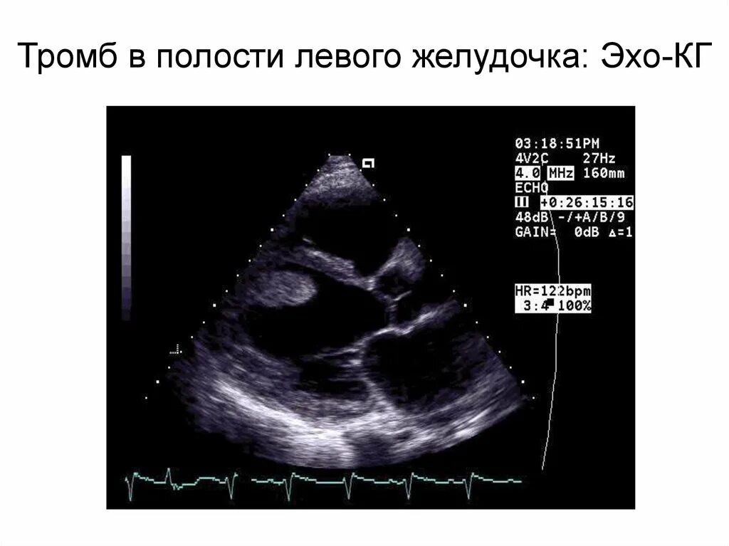 Тромб в правом предсердии эхокардиография. Тромб в левом предсердии ЭХОКГ. Тромб в левом желудочке сердца. Сердечный тромбоз