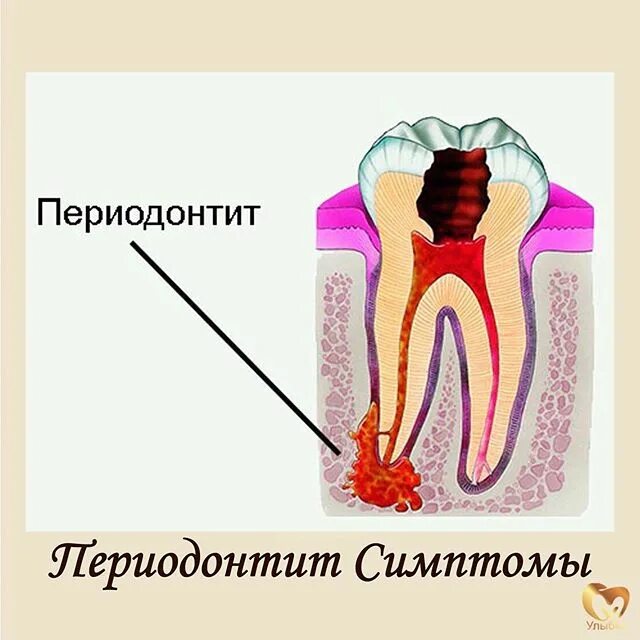 Кариес пульпит периодонтит. Пульпит периодонтит зубов.