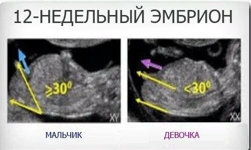 Как отличить на узи. Пол ребенка на УЗИ. УЗИ 12 недель пол ребенка. УЗИ пол ребенка мальчик. УЗИ пол ребенка девочка.