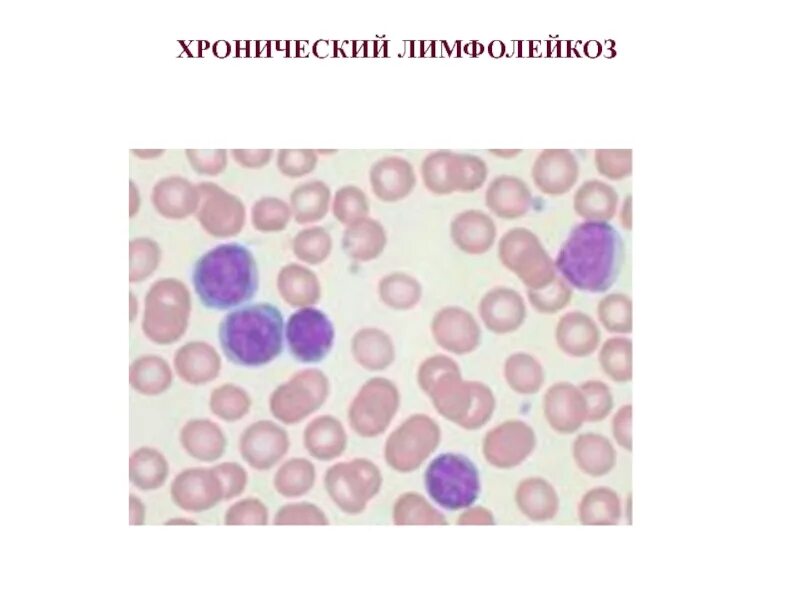 Тени Боткина Гумпрехта. Острый лимфобластный лейкоз мазок. Клетки Боткина Гумпрехта это. Кровь при лимфолейкозе