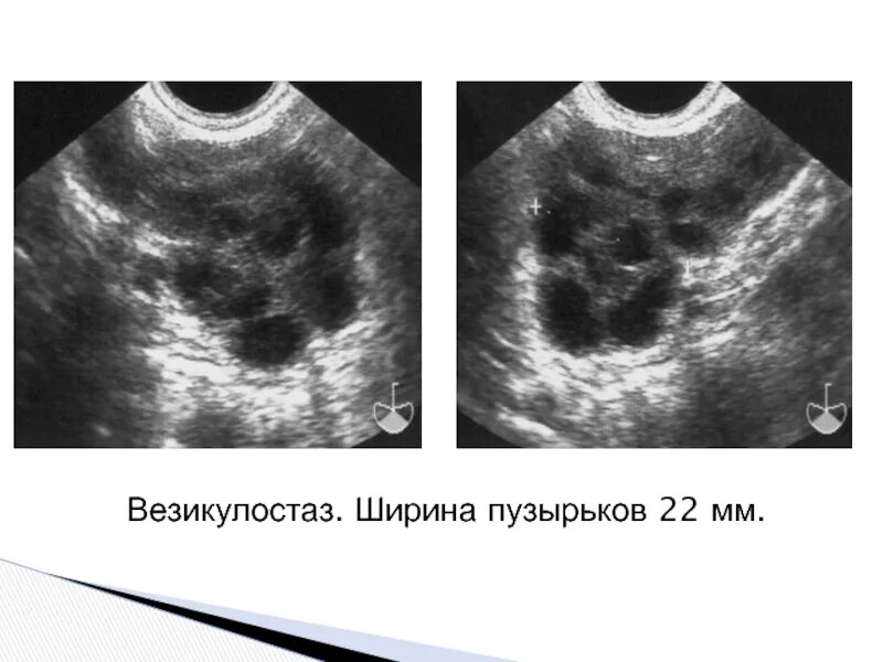 Диффузные предстательной железы. Узи простаты протокол норма. семенные пузырьки на узи в норме. трансректальное узи простаты. узи трузи предстательной железы.
