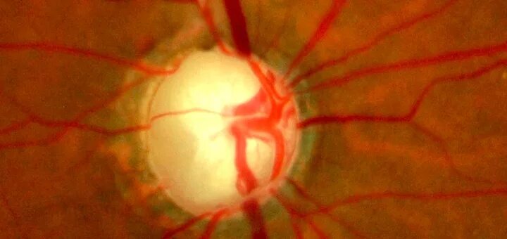 Зрительный нерв при глаукоме. Физиологическая экскавация зрительного нерва. Глаукомная атрофия зрительного нерва. Экскавация ДЗН при глаукоме. Глаукомная оптическая нейропатия зрительного нерва.
