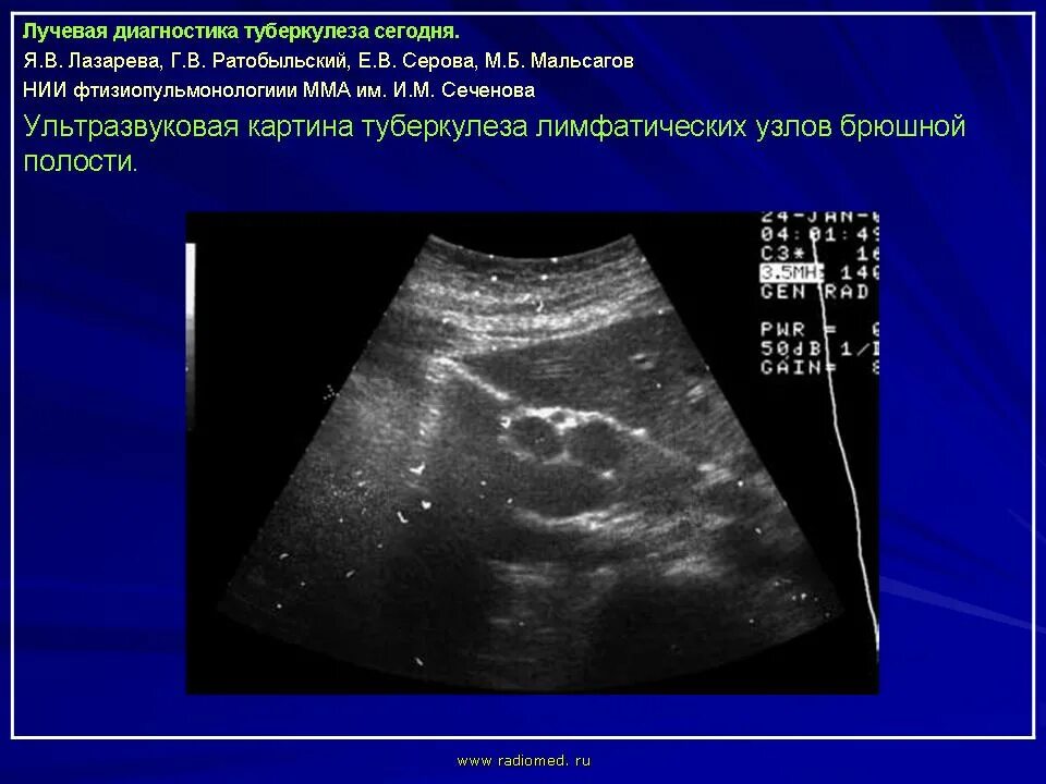 Гиперплазия лимфоузлов у детей. Мезентериальные лимфатические узлы УЗИ. Мезентериальные лимфатические узлы в брюшной полости УЗИ. Лимфоузлы брюшной полости на УЗИ.