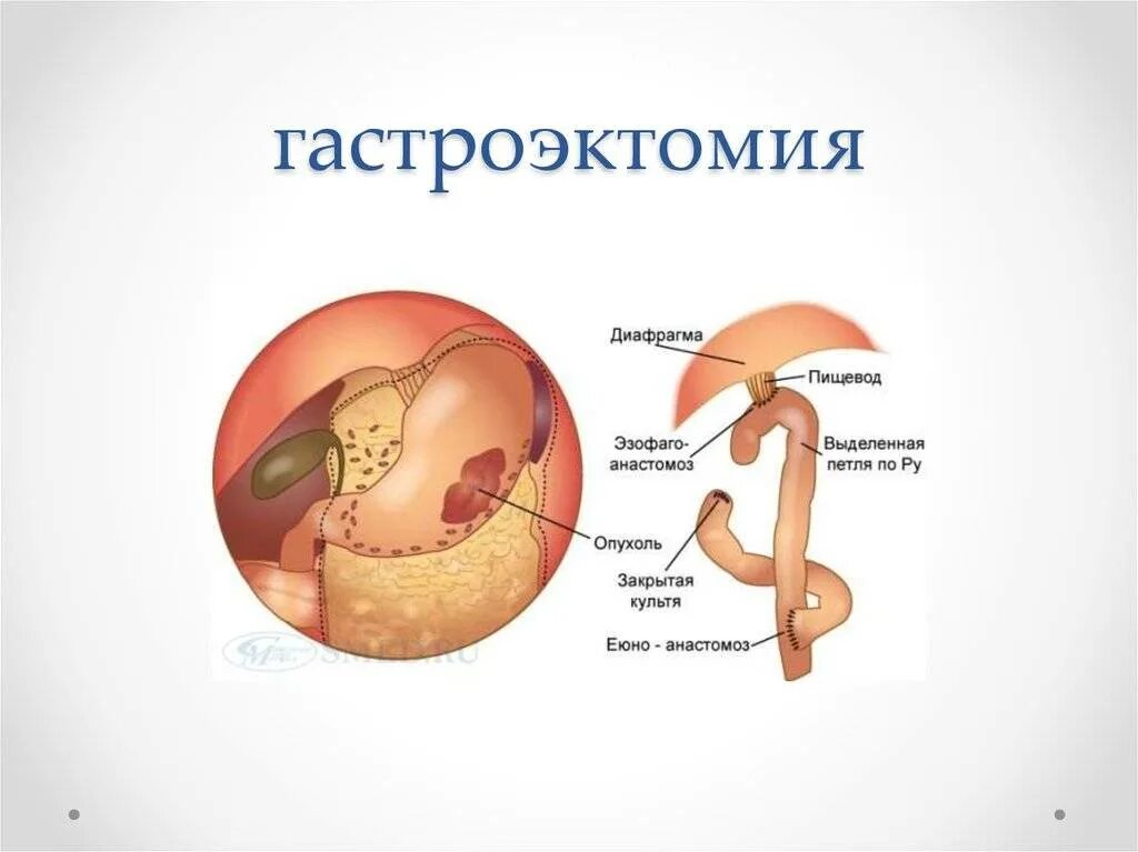 Гастроэктомия это. Лапароскопическая резекция желудка. Операция гастроэктомия желудка. Гастроэктомия желудка. Тотальная гастрэктомия.