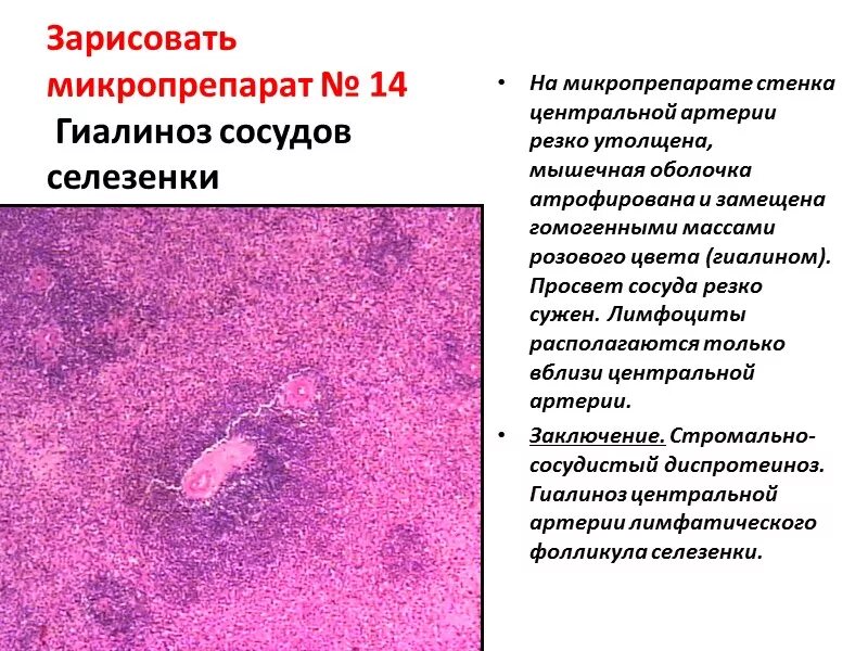 Гиалиноз сосудов селезенки макропрепарат описание. Гиалиноз артерии селезенки микропрепарат. Гиалиноз сосудов селезенки препарат описание. Глазурная селезенка патанатомия.