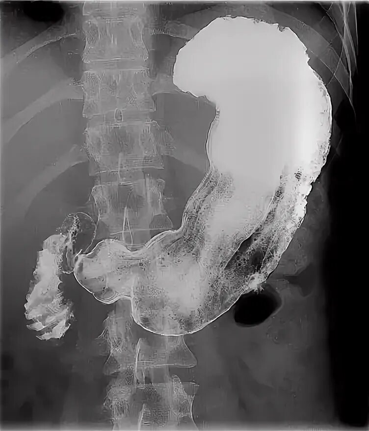 Пищевода с барием. Рентгеноскопия желудка и 12 перстной кишки. Скопия желудка рентген. Скопия пищевода рентген. Стеноз 12 перстной кишки рентген.