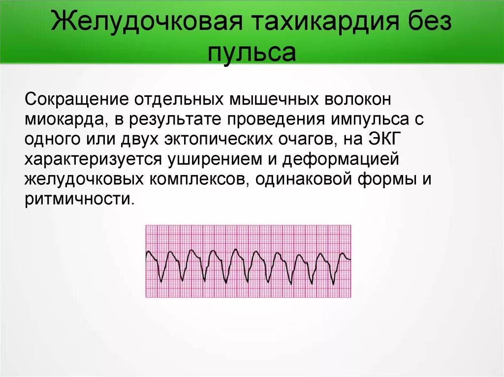 Желудочковая тахикардия без пульса. Мономорфная желудочковая тахикардия. Мономорфная желудочковая тахикардия ЭКГ. Желудочковая тахикардия без пульса на ЭКГ.