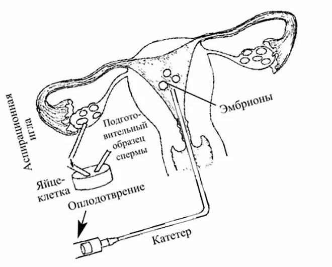 Почему подсаживают. Искусственное оплодотворение женщины. Искусственное оплодотворение схема. Катетеры для оплодотворения. Экстраполярное оплодотворение.