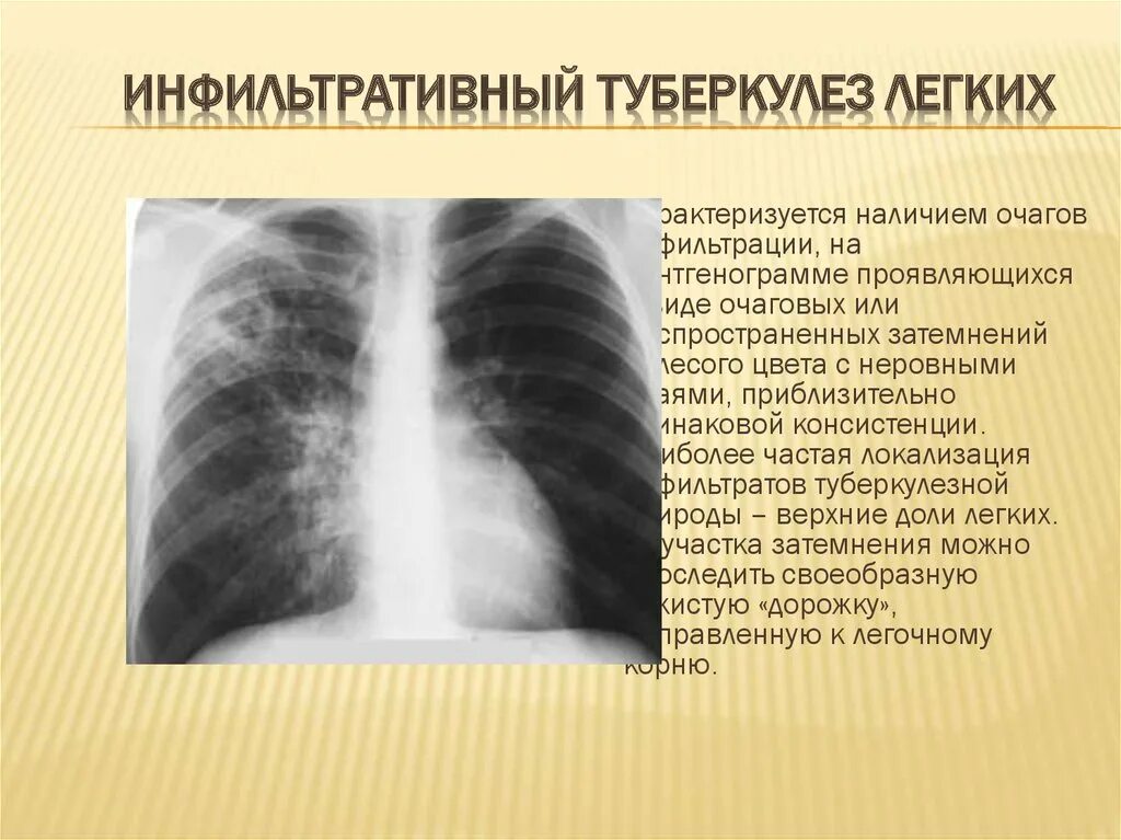 Изменения в верхней доле легкого. Инфильтративный туберкулез рентгенография. Инфильтративный туберкулёз лёгких рентген. Инфильтративный туберкулез при рентгене. Очагово-инфильтративный туберкулез рентген.