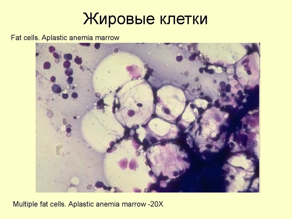 Клетки костного мозга. Жировая реконверсия костного мозга. Жировые клетки в костном мозге. Жировые клетки под микроскопом.