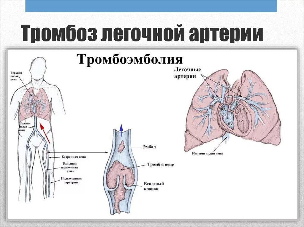 Артериальная тромбоэмболия