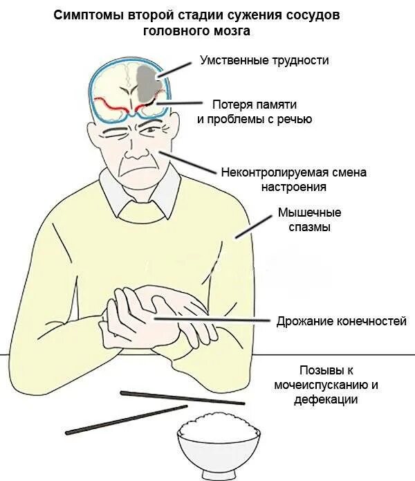 Сужение сосудов последствие. Сужение сосудов головного мозга. Сужение сосудов головного мозга симптомы. Сужение сосудов головы симптомы. Спазм сосудов головного мозга симптомы.