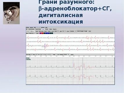 Интоксикация на экг