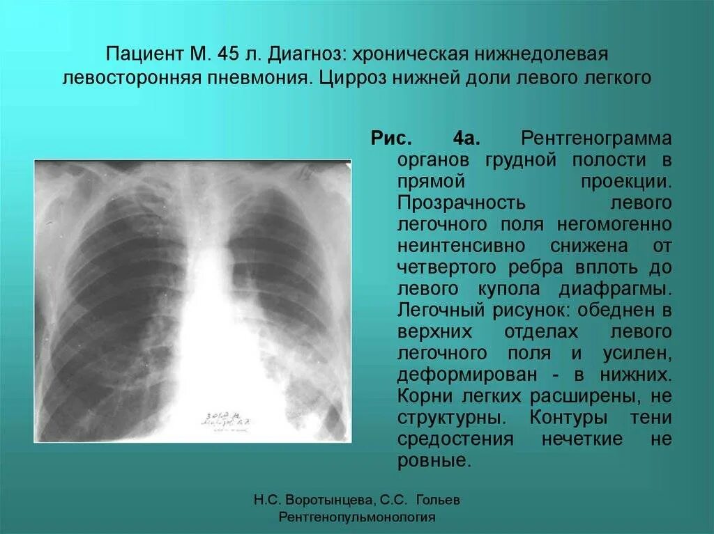 Пневмония в правой нижней доле. Нижнедолевая очаговая пневмония рентген. Левосторонняя нижнедолевая пневмония рентген. Левосторонняя нижнедолевая пневмония рентгенограмма. Правосторонняя нижнедолевая очаговая пневмония рентген.