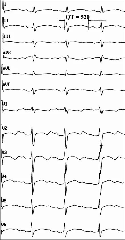 Удлиненное qt у ребенка. Синдром удлиненного qt на ЭКГ. Синдром удлиненного интервала qt на ЭКГ. Удлиненный qt на ЭКГ. Удлиненный интервал qt на ЭКГ что это такое.