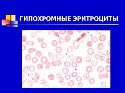 Гипохромия что это