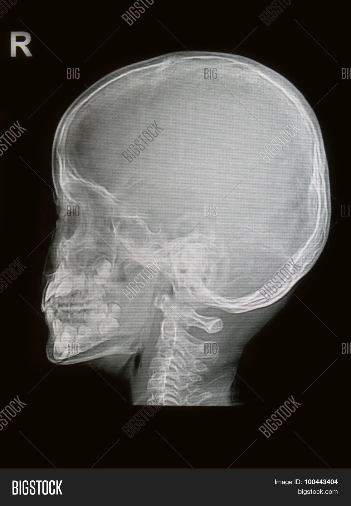 Снимок черепа новорождённого. Рентген черепа новорожденного.