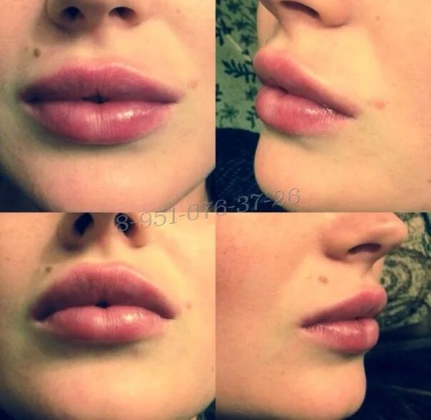 Губы Джоли техника увеличения. Губы Джоли техника увеличения губ. Форма губ Джоли. Губы эффект Джоли.