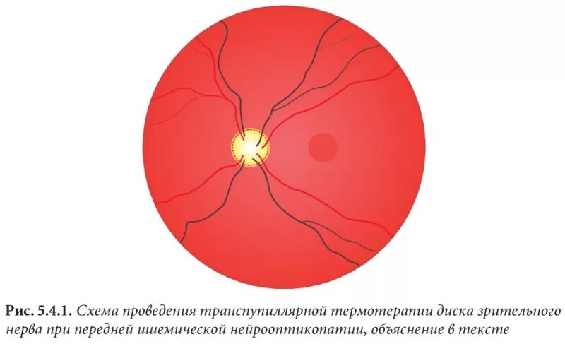 Ишемическая нейропатия зрительного нерва. Передняя ишемическая нейропатия зрительного нерва. Передней ишемической нейропатии зрительного нерва. Ишемическая оптическая нейропатия обоих глаз. Нейропатия глаза