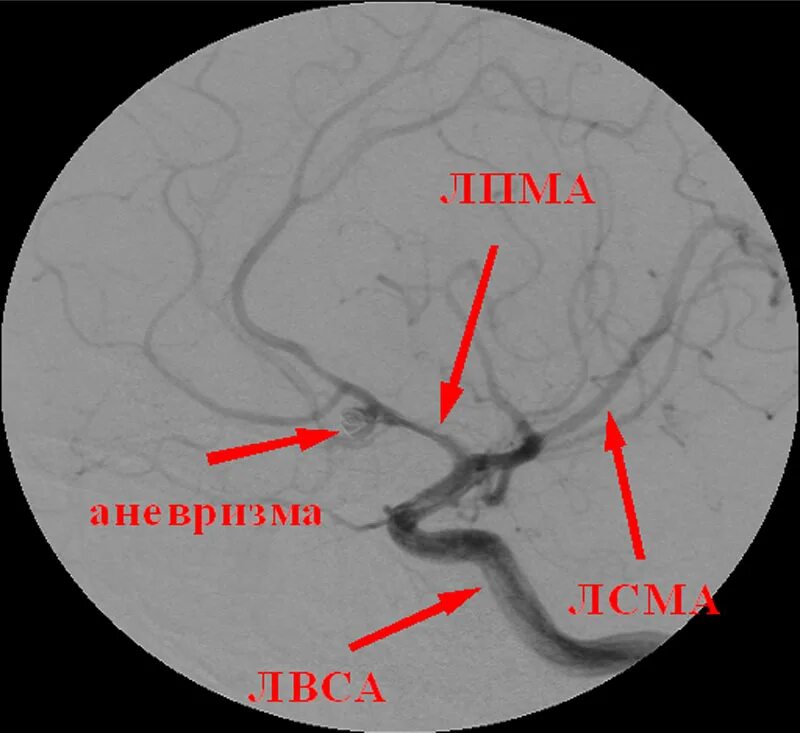 Церебральный вазоспазм. Вазоспазм сосудов головного мозга. Вазоспазм сосудов головного мозга на УЗИ. Сегмент а1 пма
