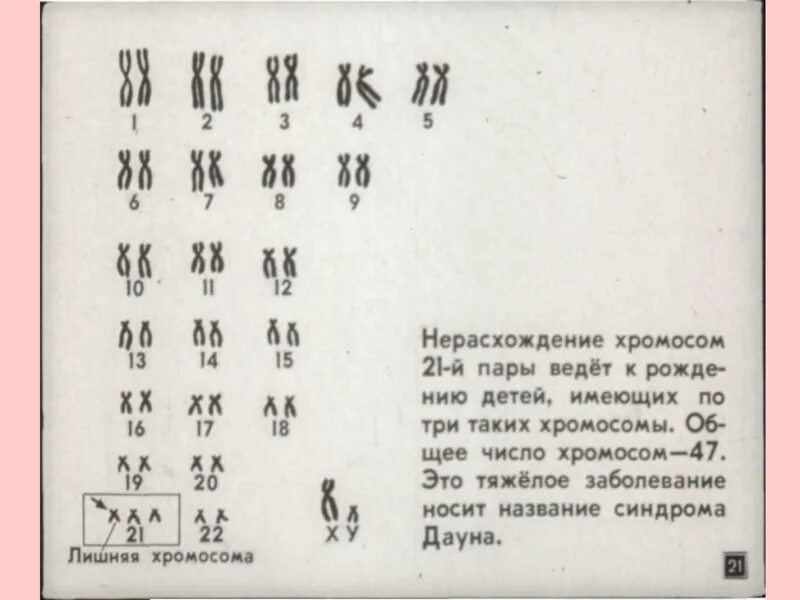 Лишняя хромосома в 21 паре. Лишняя хромосома в 23 паре. Лишняя хромосома в 12 паре. Наличие лишней хромосомы