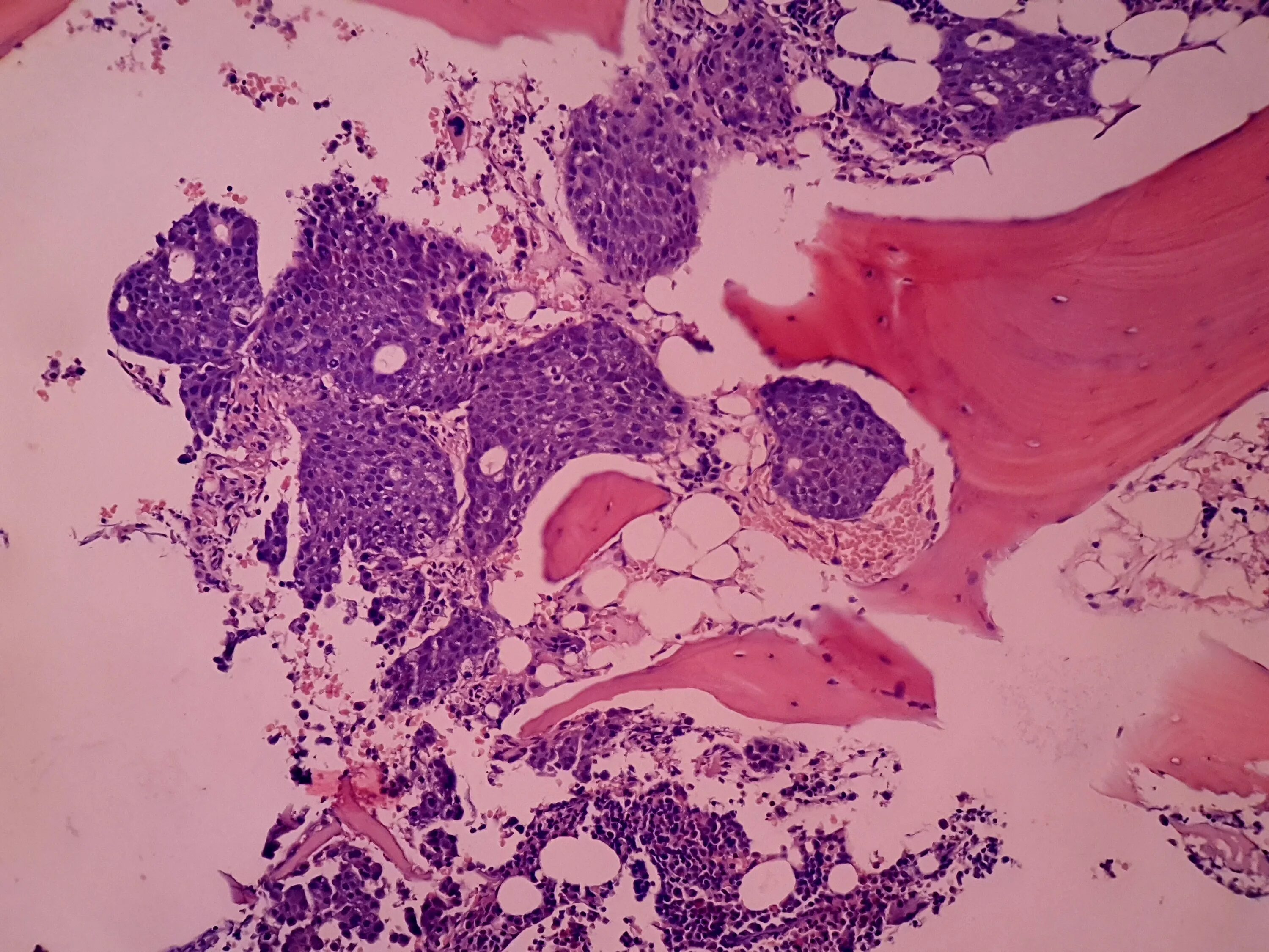 Metastasis