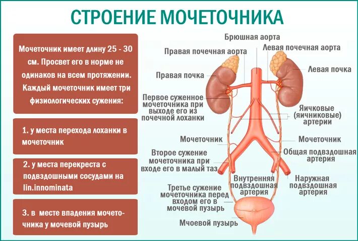 Суждения мочеточника