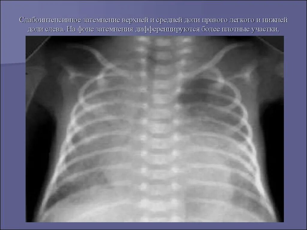 Затемнение верхней доли легкого. Респираторный дистресс синдром новорожденных рентген. РДС новорожденных рентген. ОРДС У новорожденных рентген. Респираторный дистресс синдром на рентгенограммах.