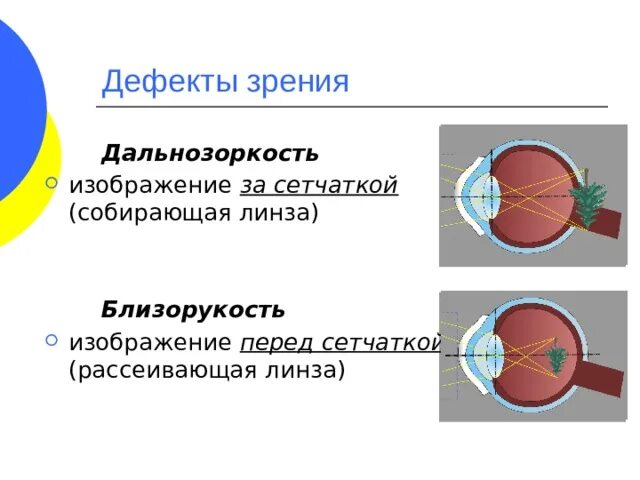 Дефекты зрения ответы. Дефекты зрения дальнозоркость. За сетчаткой близорукость. Дальнозоркость за сетчаткой. Дефекты зрения физика.