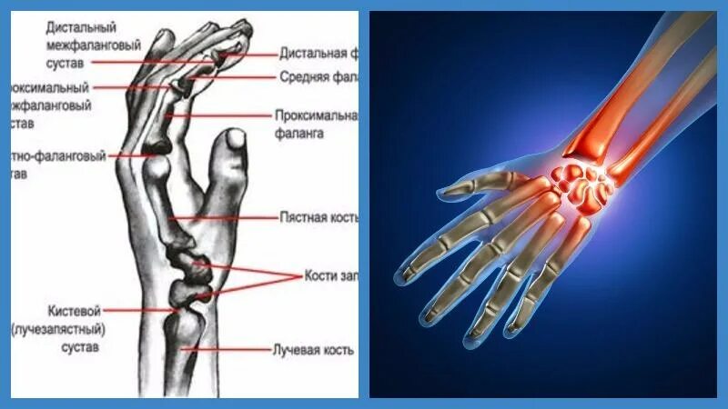 2 Пястно фаланговый сустав кисти. 1 Пястно-фаланговый сустав кисти. Артроз лучезапястного сустава 2ст. Запястно пястный сустав анатомия. Артрит фаланговых суставов