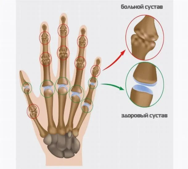 Усиленные суставы. Широкие суставы пальцев.