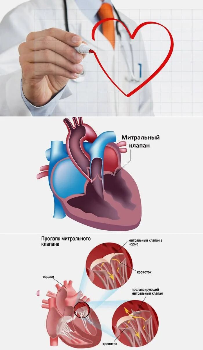 Что такое пролапс митрального клапана. Пролапс митрального клапана 1 степени. Пролапс митрального клапана 1 степени 1. Пролапс двустворчатого клапана. Пролапс сердца 1 степени.