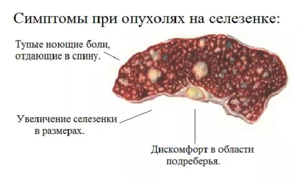 Симптомы селезенки боли в левом. Симптомы болезненной селезенки. Опухоль селезенки симптомы. Новообразования селезенки.