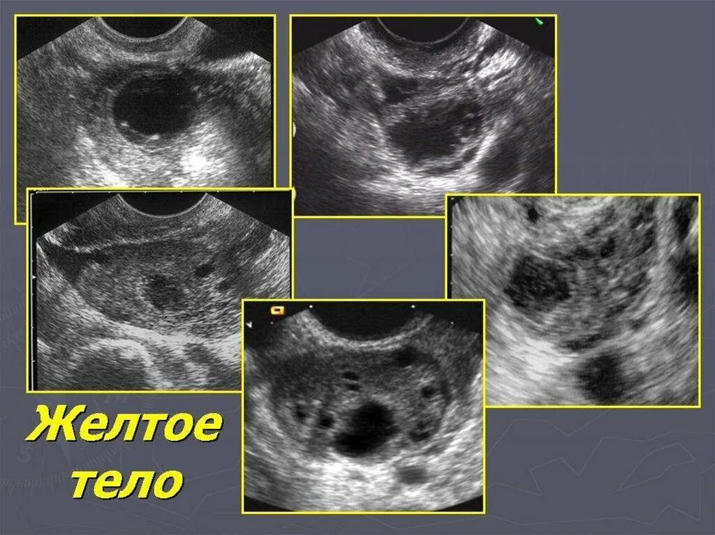 Желтое тело что это значит простыми словами. Жёлтое тело в яичнике на УЗИ. Киста и фолликул яичнике УЗИ. Кисты яичника УЗИ картина. УЗИ картина кисты желтого тела.