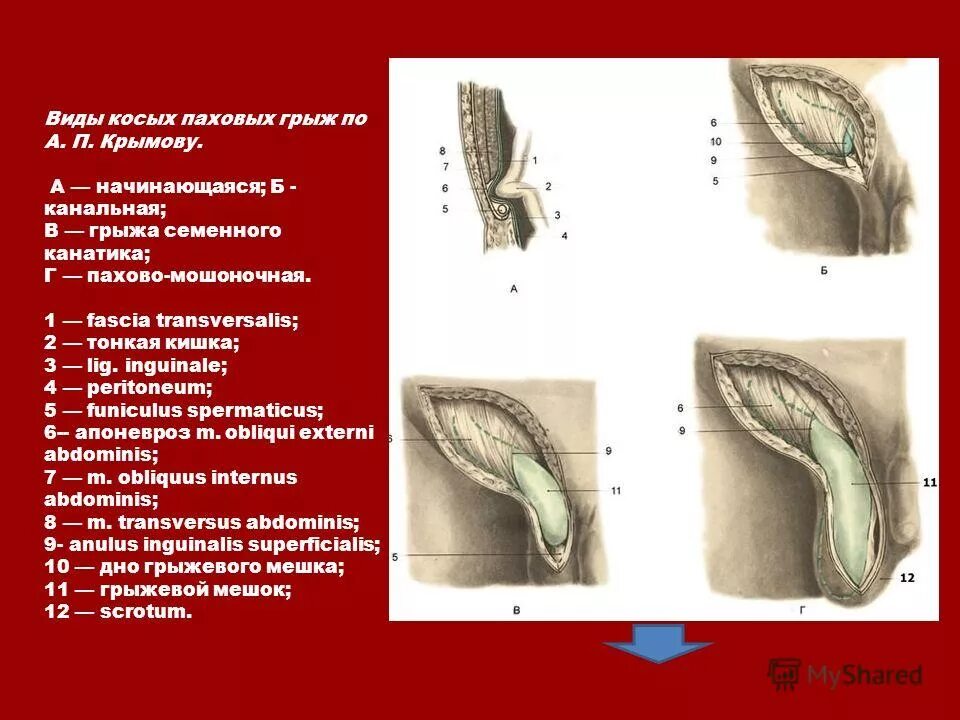 Врожденная косая паховая грыжа схема. Прямая и косая паховые грыжи