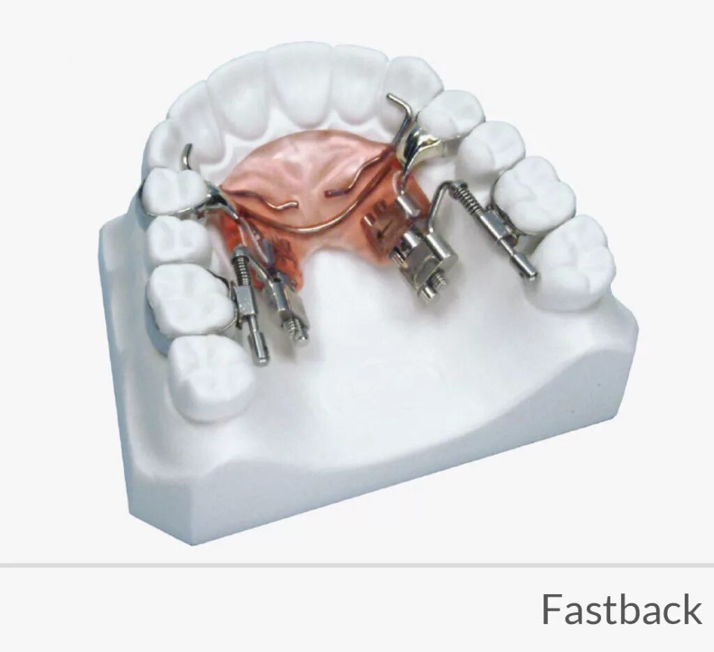 Аппарат для дистализации моляров. Аппарат Pendulum ортодонтия. Аппараты для дистализации моляров на верхней челюсти. Дистализация моляров ортодонтия. Fast back