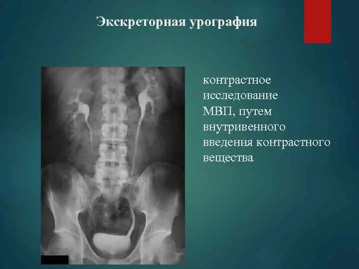 Урография с контрастом. Экскреторная урография с контрастом. экскреторная урография введение вещества. внутривенная экскреторная урография. экскреторная урография контрастное вещество.