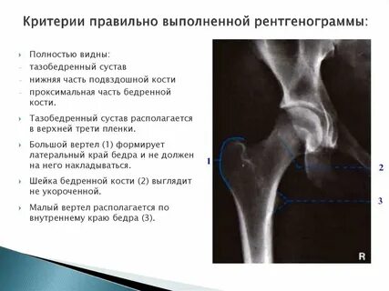 Тендиноз тазобедренного сустава лечение у женщин