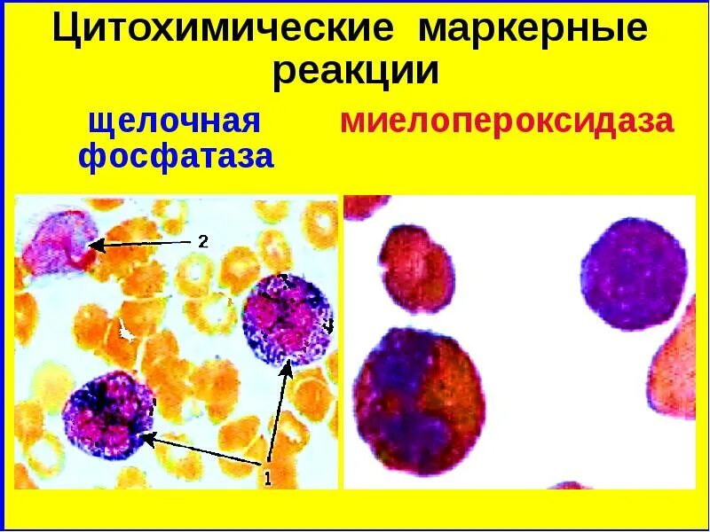 Цитохимические исследования. Цитохимические методы исследования. Морфология гранулоцитарных клеток. Клетки гранулоцитарного ряда. Реакция на лейкоциты положительная