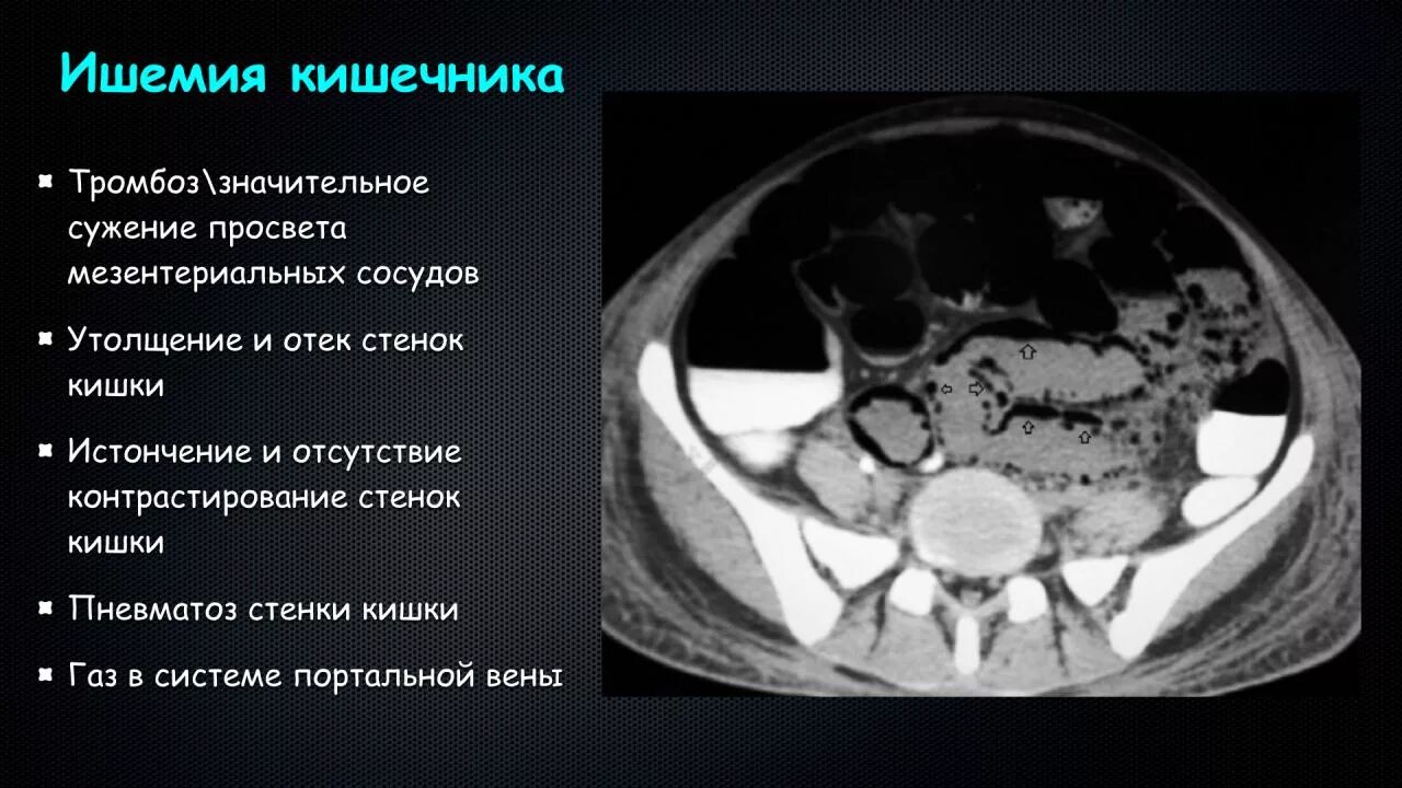 Брюшная ишемия. Тромбоз мезентериальных сосудов на кт. Тромбоз мезентериальных сосудов кишечника кт. Нерохз кишечника на кт.