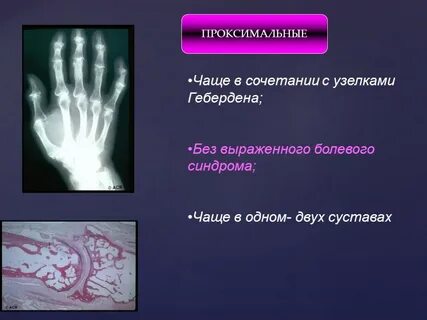 Проксимальные межфаланговые
