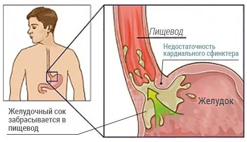 Кардиальный жом не смыкается. Недостаточность кардиальный сфинктер это. Кардия пищевода анатомия. Сфинктер между желудком и пищеводом. Пищеводно желудочный сфинктер.