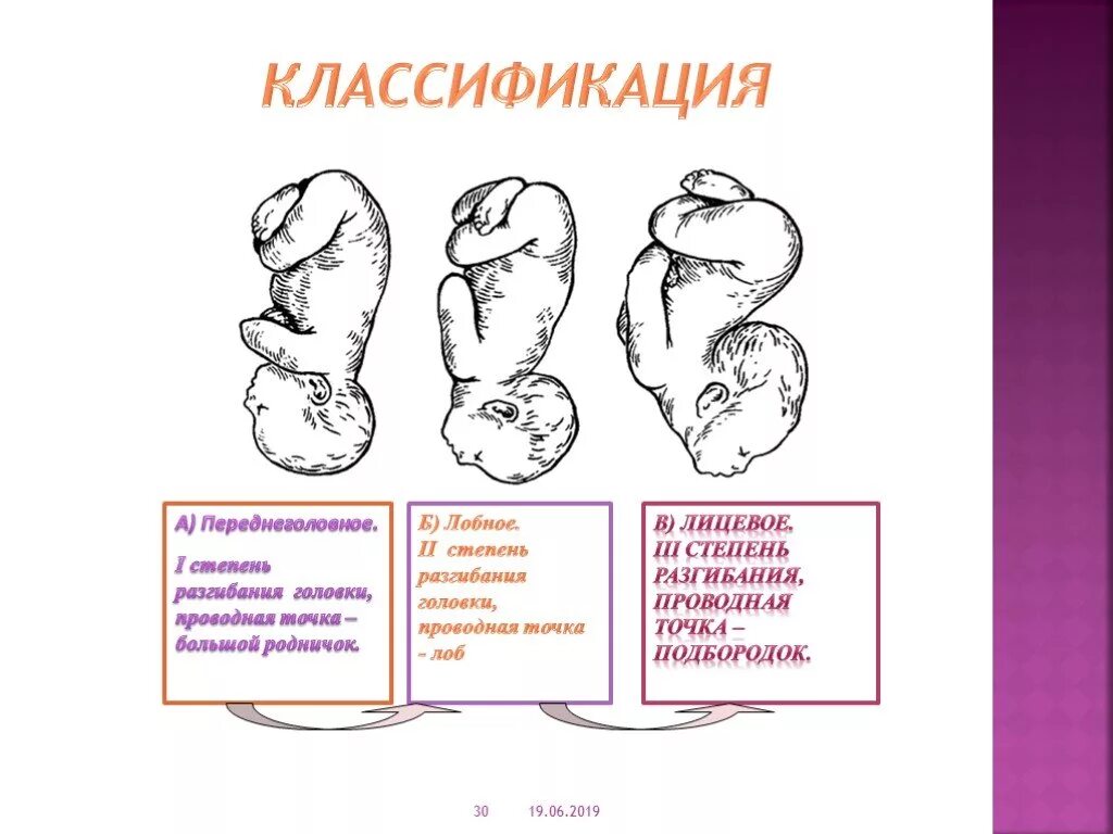 Переднеголовное предлежание плода биомеханизм родов. Биомеханизм родов при переднеголовном предлежании. Переднеголовное разгибание головки. Степень вставления головки плода. Переднеголовное предлежание