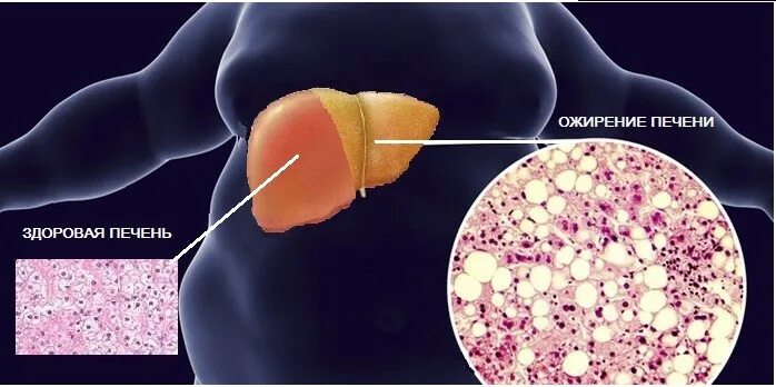 Жировая печень симптомы у мужчин